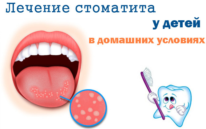 Как лечит стоматит в домашних условиях у детей Как лечит стоматит в домашних условиях у детей
